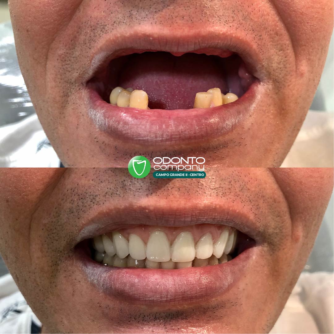 Próteses Fixas | Protocolo Dentário
